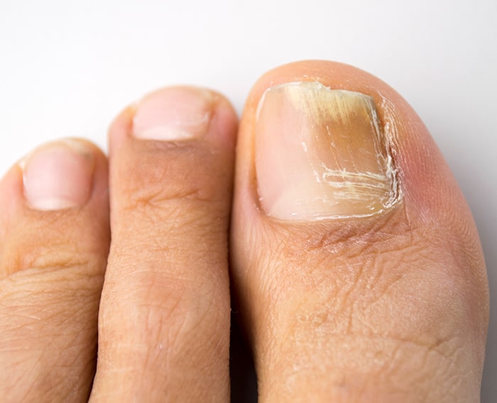 Infecția micotică a unghiei